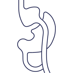 تجاوز الأمعاء